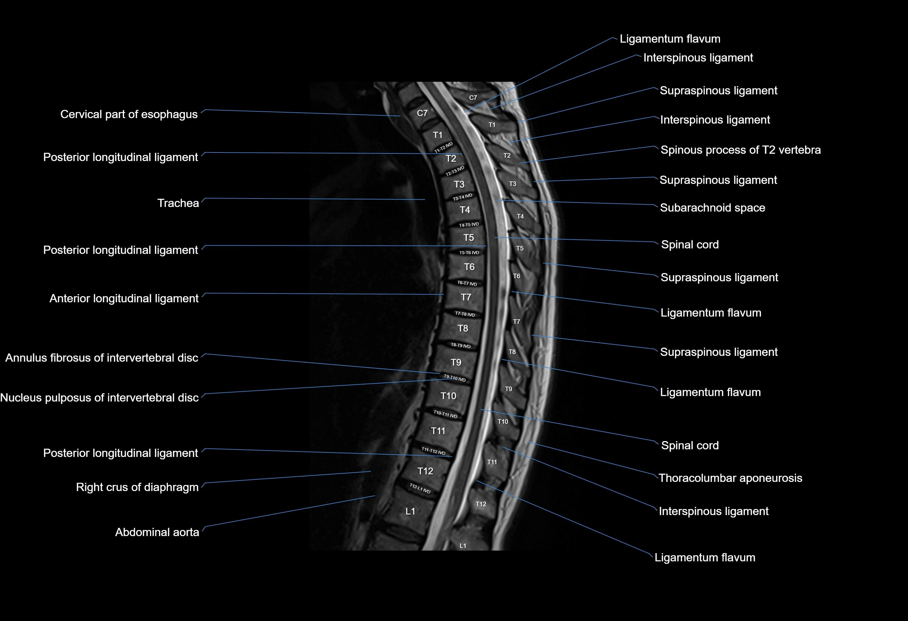 MRI thoracic spine sagittal  cross sectional anatomy 3T radiology  image-img-00001-00012.webp